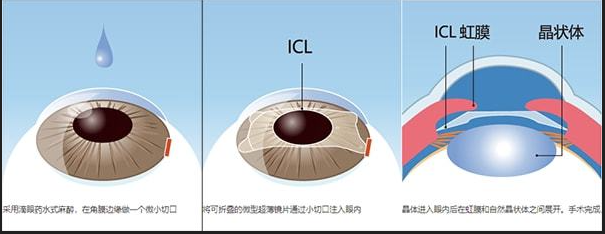 ICL晶体可以在眼睛内放多久？需要更换吗？