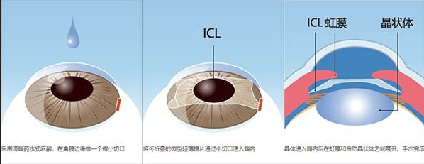近视手术的主要类型：激光类与晶体植入类详解