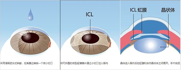 高度近视更适合ICL晶体植入手术