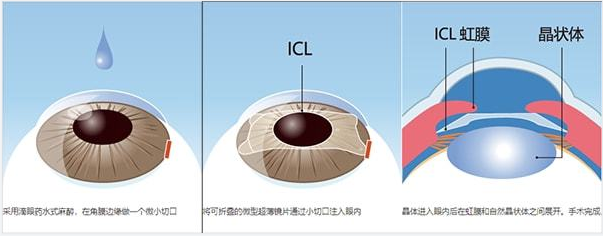 ICL晶体植入手术：不需要住院，但需留院观察