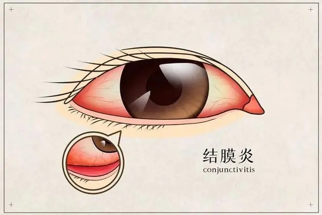 角膜炎VS结膜炎：你分得清吗？