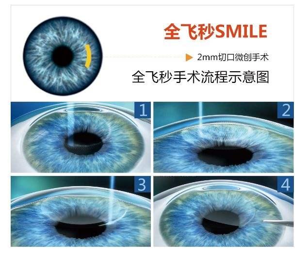 全飞秒近视手术VS传统近视手术