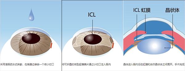 高度近视患者的福音