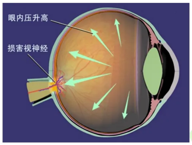 北京爱尔英智眼科医院李秋梅提醒您，经常关灯看手机或诱发青光眼！