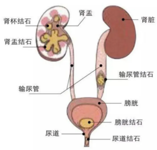 从急性绞痛到长效防复！无锡结石患者完整中西医诊疗流程