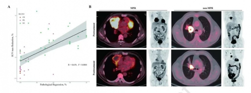 【IF=20】ctDNA MRD技术助力肺癌免疫新辅助研究精准疗效预测