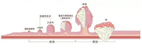 广州东大肛医院可信吗？查出癌前病变别紧张