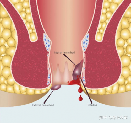 广州东大肛肠医院是正规的吗？收费怎么样