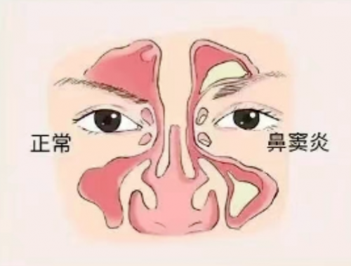 沈阳燕都医院口碑咋样？鼻窦炎的症状你了解多少