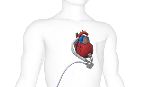吉大一院心脏外科成功植入吉林省首颗左心室辅助装置人工心脏