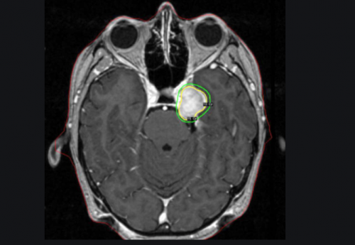 脑膜瘤科普：恶性脑膜瘤可能存在转移风险