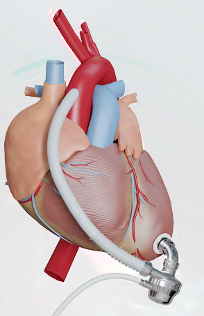 无锡医疗界新突破，首例“人工心脏”植入手术成功
