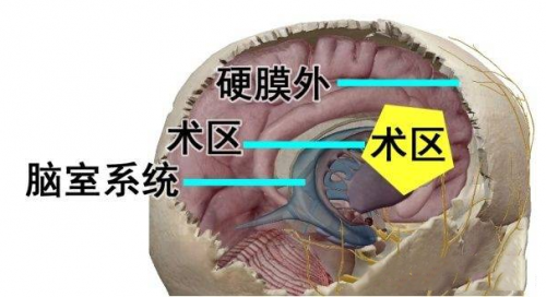 北京精诚博爱医院提倡“分层引流”技术在颅内感染治疗中的重要意义