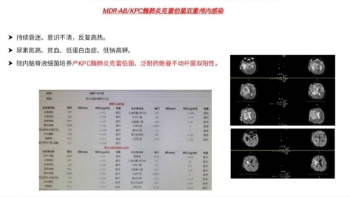 北京精诚博爱医院提倡“分层引流”技术在颅内感染治疗中的重要意义-热点健康网