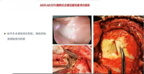 北京精诚博爱医院提倡“分层引流”技术在颅内感染治疗中的重要意义-热点健康网