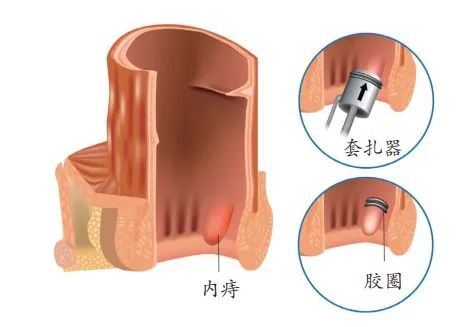 广州东大肛肠医院“痔疮是小病”不用太担心！真的是这样吗？