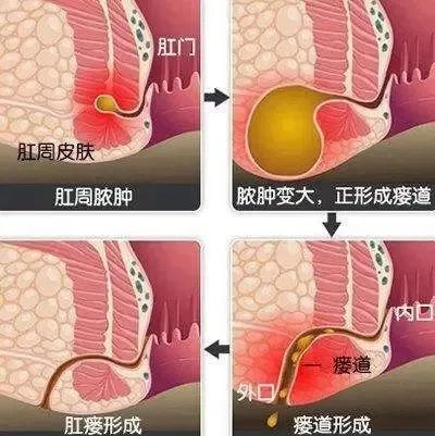 广州东大肛肠医院好不好体出现这五个症状，警惕肛瘘！