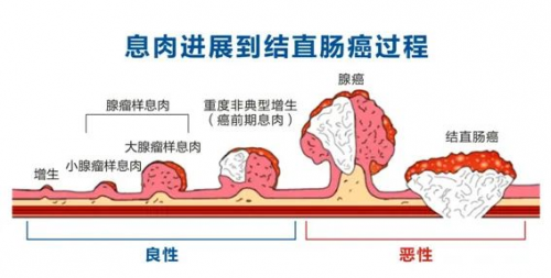 广州东大肛肠医院好不好肠息肉有哪些症状？