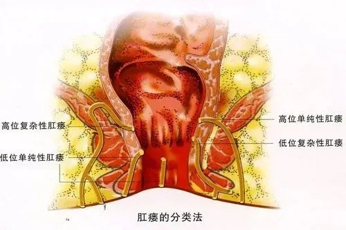 广州东大肛肠医院评价等待肛周脓肿自愈你在把自己推向火坑!