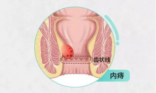 广州东大肛肠医院黑不黑猫投诉痔疮肉球脱出时，应该怎么办？