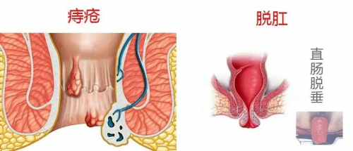 肛门有血包图片图片