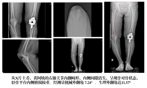 六盘水华佗正骨医院骨科国家队高难度膝关节置换成功