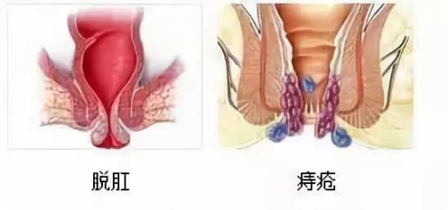 痔疮啥样图片 脱出图片