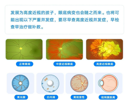 近视管理到爱尔,闪亮明眸新学期(图7) 近视管理到爱尔,闪亮明眸新学期(图7)