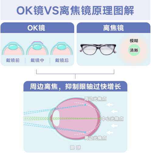 OK镜与离焦眼镜:兰州爱尔眼科范真院长深度解析孩子近视防控的优选方案(图2) OK镜与离焦眼镜:兰州爱尔眼科范真院长深度解析孩子近视防控的优选方案(图2)