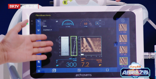 00后演员竟也重度脂肪肝？福瑞股份FibroScan®的独家早筛技术让肝脏不再沉默
