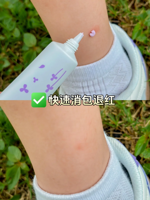 寶寶太招蚊子被叮咬后哭鬧不止怎么辦