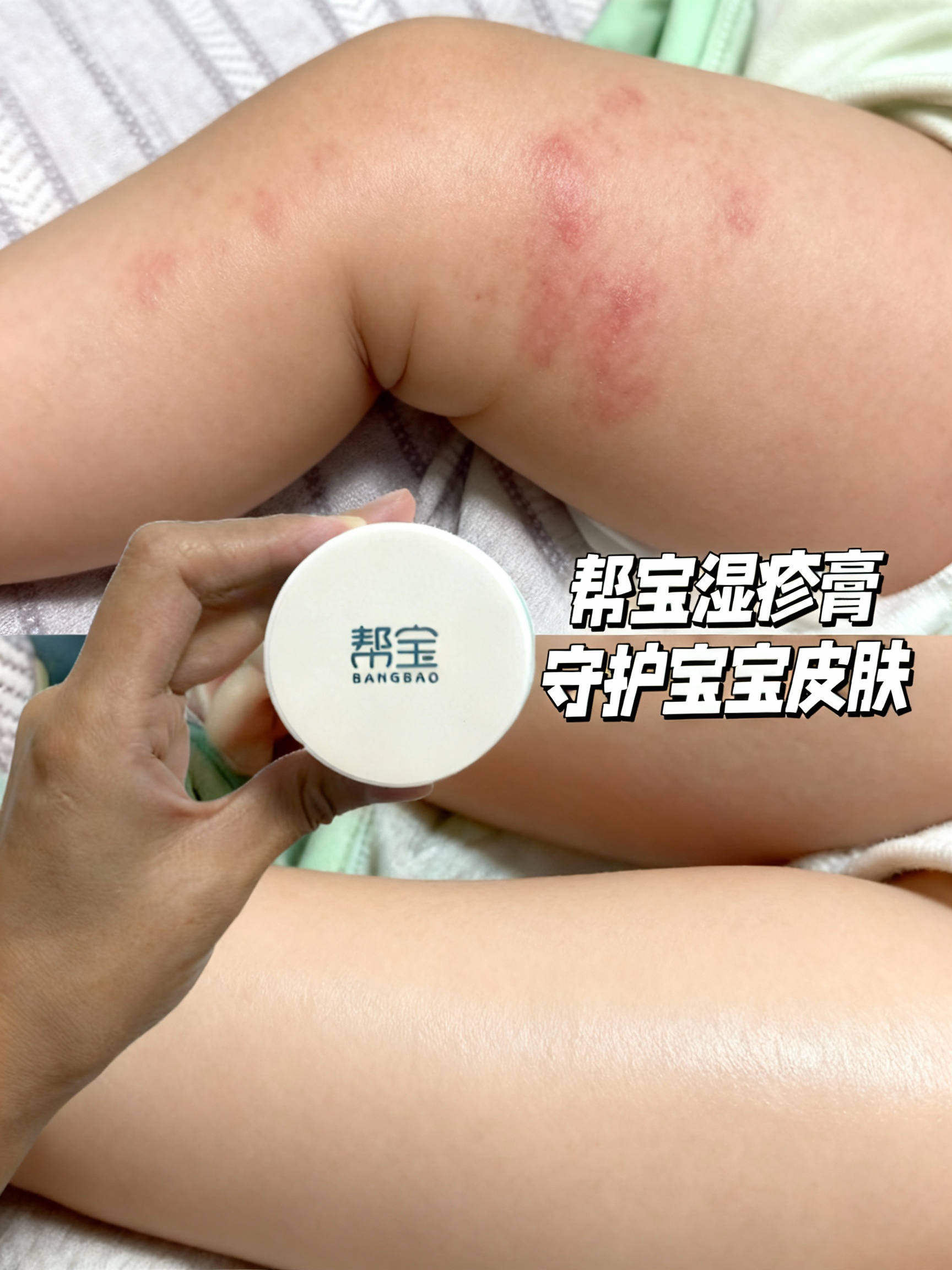 宝妈必看：宝宝湿疹怎么快速消退的有效方法分享