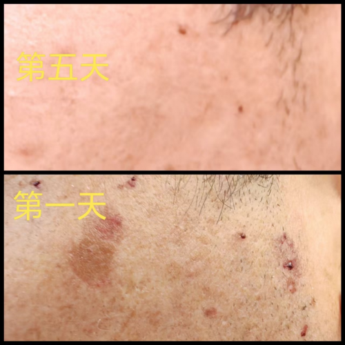 等离子体活化介质技术 ——重塑皮肤疤痕修复的技术维度与核心优势解析