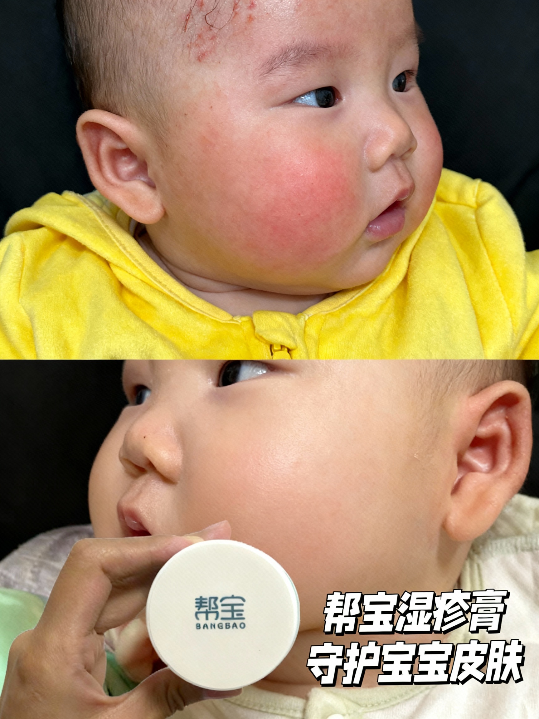 宝宝面部湿疹怎么处理？宝妈必看的科学护理方法