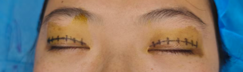 项昌峰医生精雕轮廓,重塑自信 —— 走进武汉科技大学附属武汉紫荆医院颌面整形中心