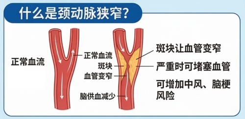 颈动脉狭窄治疗