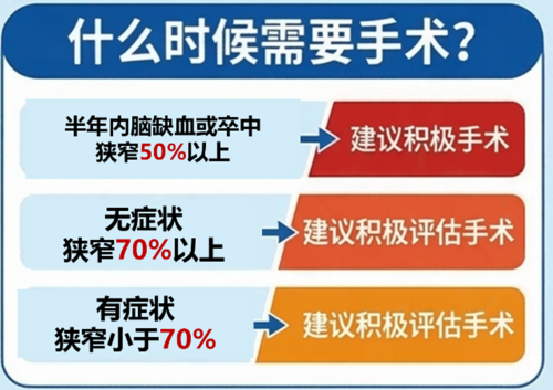 颈动脉狭窄治疗