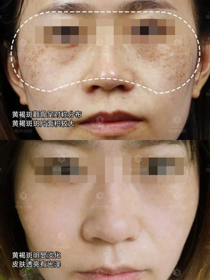 别再盲目打激光!杨禅中博士专属溶斑技术祛斑不损肤、长效不反弹(图3)