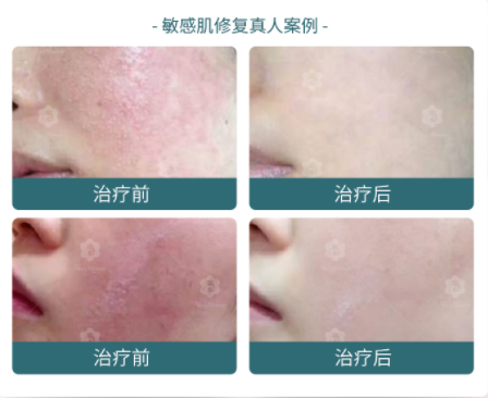 告别“玻璃肌”!皮肤科专家许剑伦主任亲授敏感肌修复秘诀 告别“玻璃肌”!皮肤科专家许剑伦主任亲授敏感肌修复秘诀