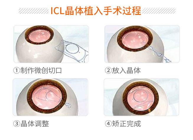 全飞秒+ICL双证绵阳近视手术专家——绵阳华厦陈静：金杯银杯，不如摘镜族口碑！