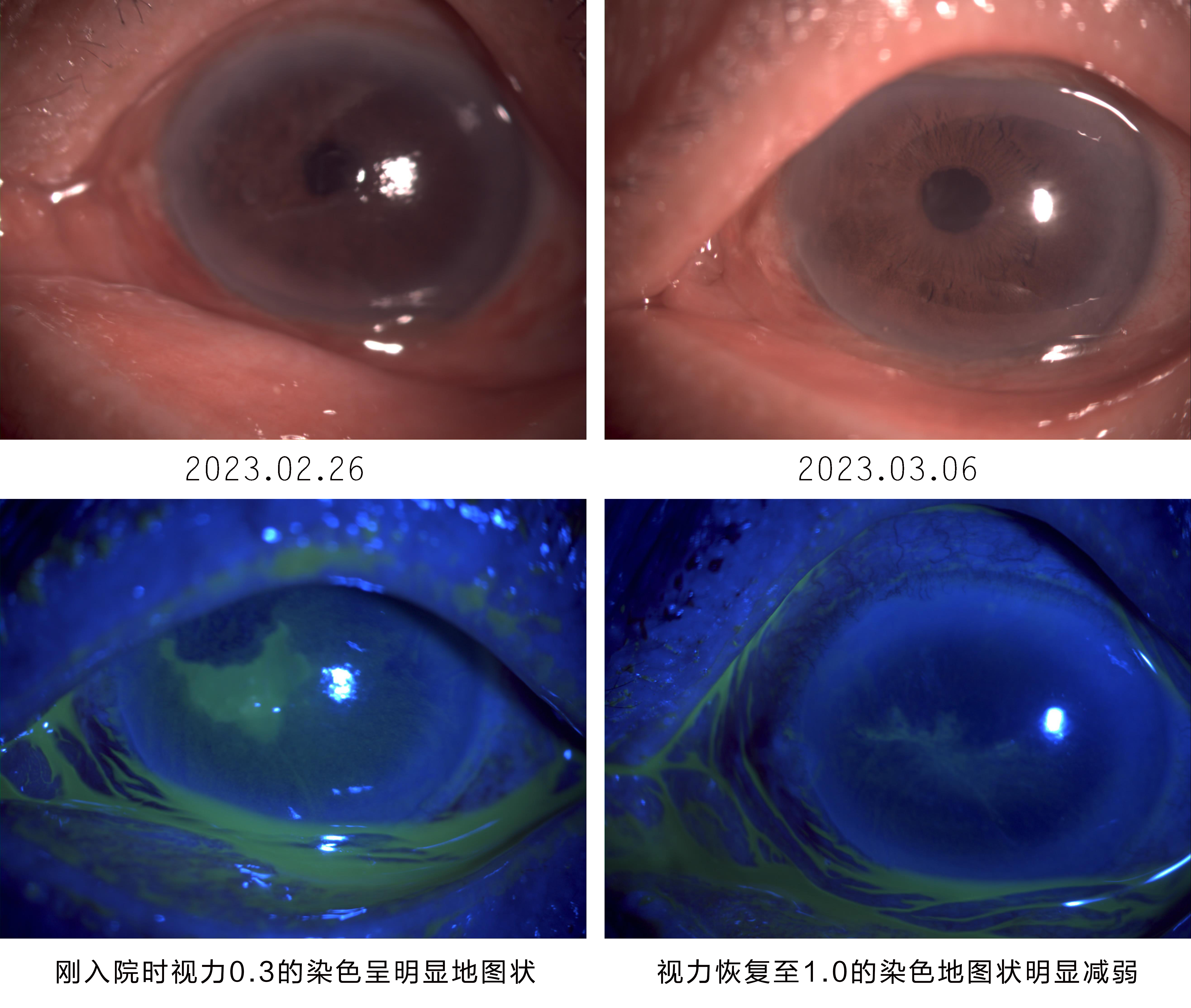 视力从0.3到1.0，单疱病毒性角膜炎的抗“毒”大作战