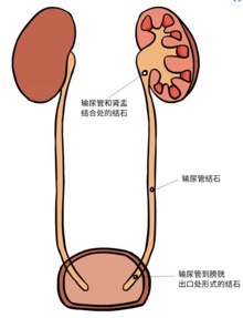 尿石通丸提醒广大国民关注结石问题，重视以下上尿路结石主要症状