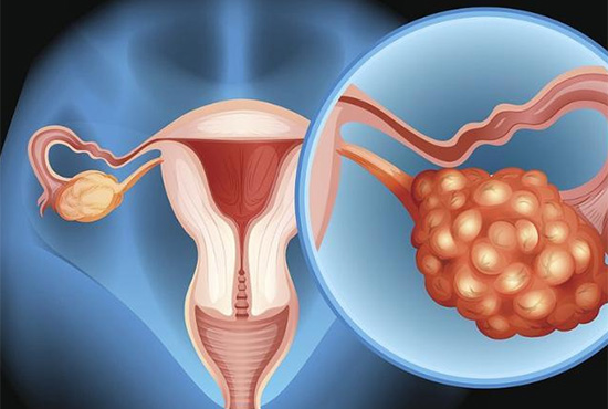 女性腹围短期内增大，广州仁爱天河医院妇科主任表示警惕卵巢疾病