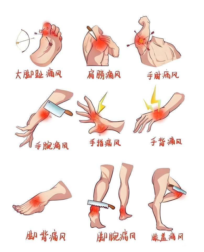 肿节风胶囊对痛风的有效治疗