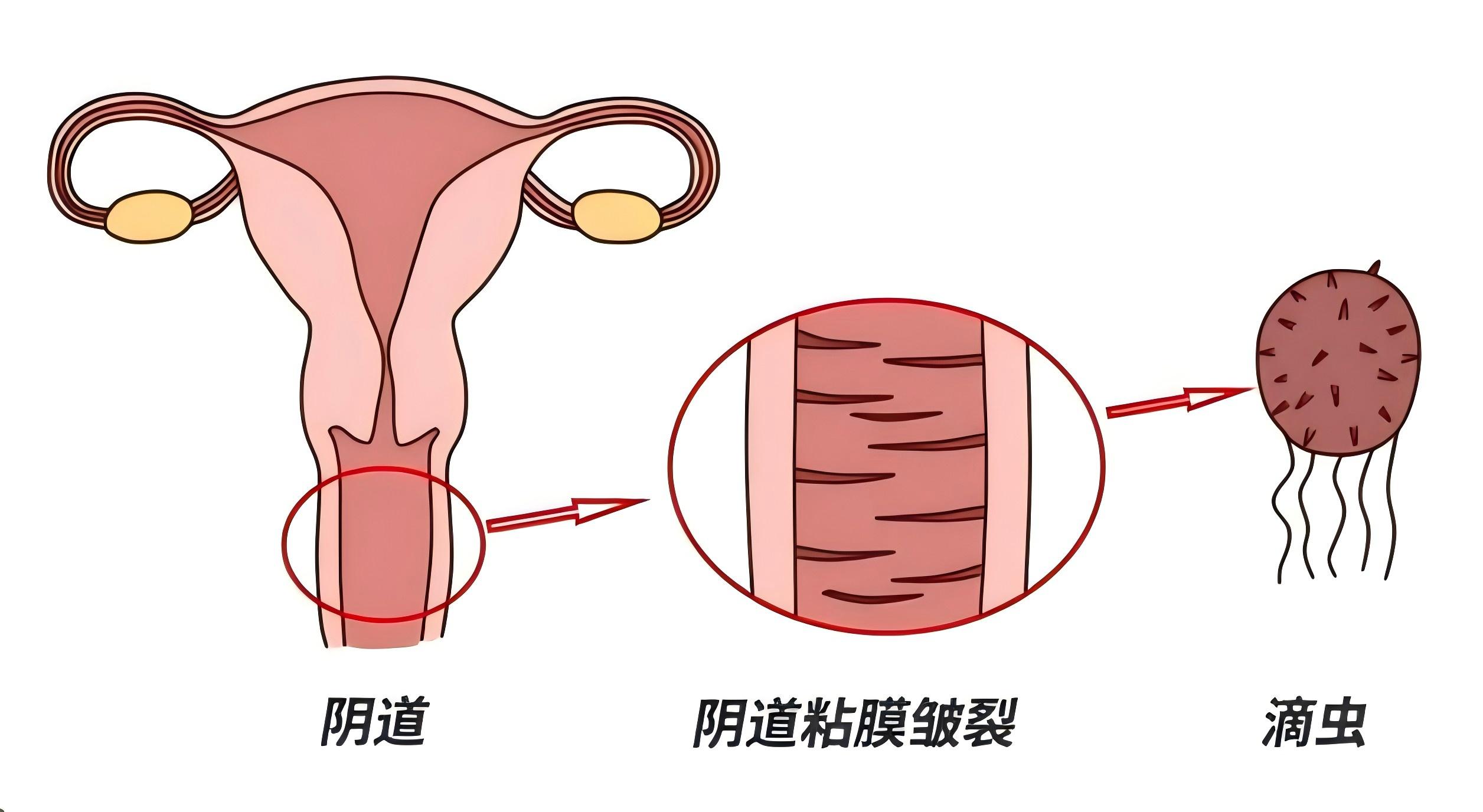 滴虫