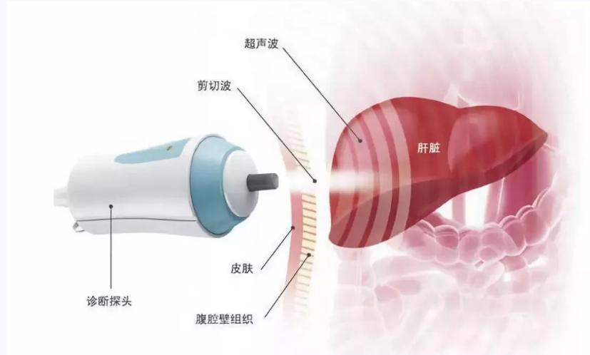 强肝胶囊对非酒精性单纯性脂肪肝FibroScan值的影响