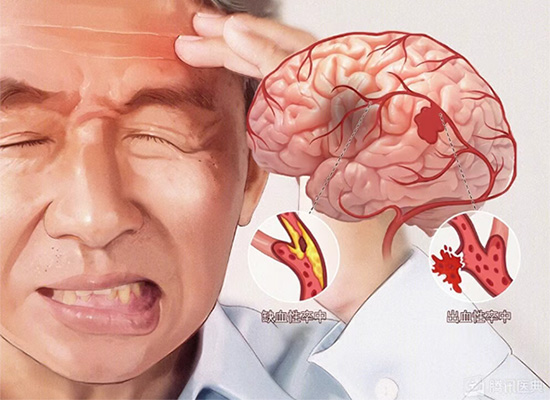 54岁保安脑梗后偏瘫，揭秘其90天从卧床到行走的康复秘诀