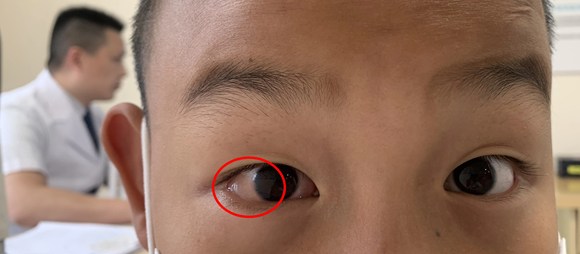 8岁孩子揉眼揉出“水泡”！永春爱尔眼科提醒：频繁揉眼需警惕结膜水肿