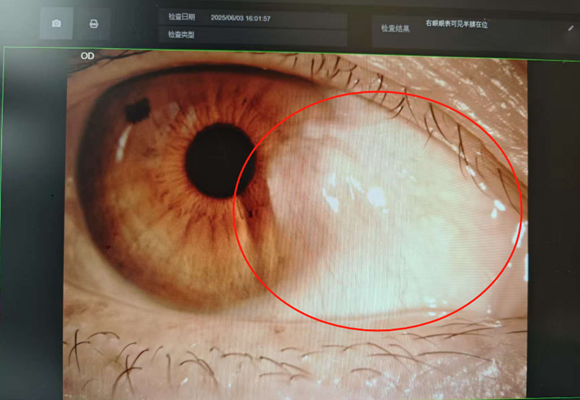 警惕眼睛里长出的 “小翅膀”！永春爱尔眼科睛致胬肉手术，生物羊膜技术解难题