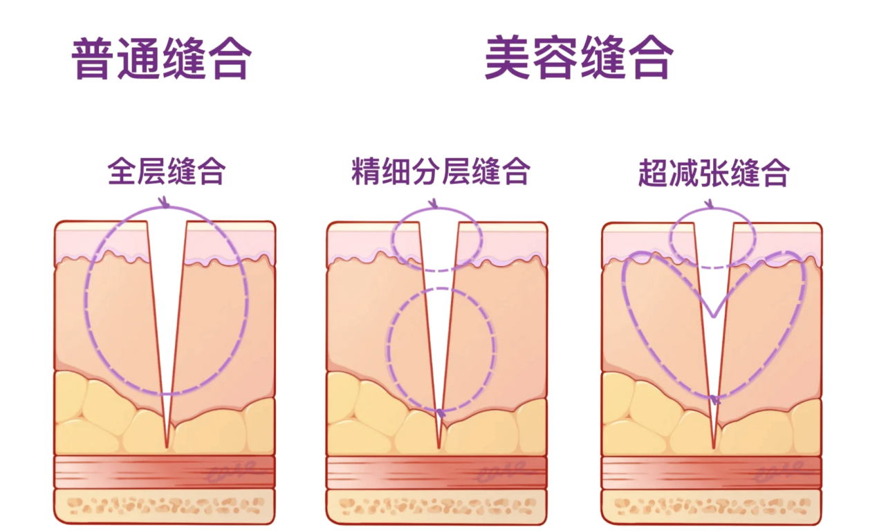 手被料理机割伤怎么办? 外科医生教你安全急救指南 手被料理机割伤怎么办? 外科医生教你安全急救指南